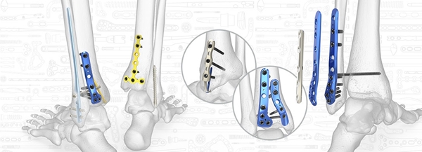 Acumed Ankle Plating System 3 | OneMed