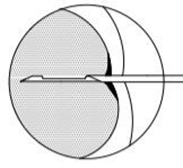 Super Core biopsianeula, 18G 9cm neula steriili 1kpl - 2