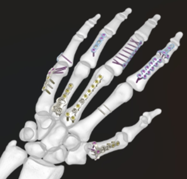 Acumed Hand Fracture System | OneMed