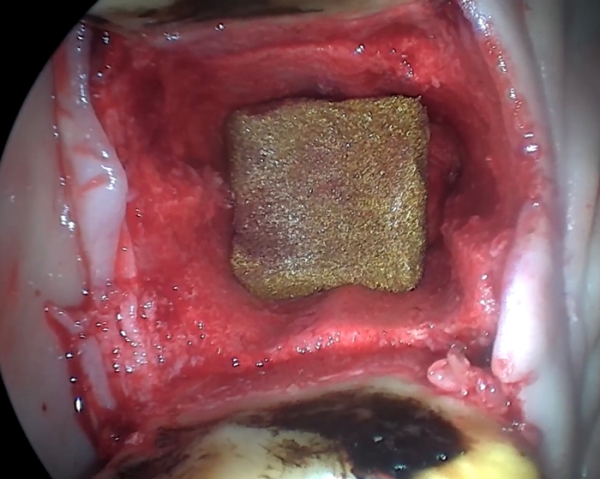 iM3 Airgid hemostaatti suuri, 20x20mm 20kpl - 2