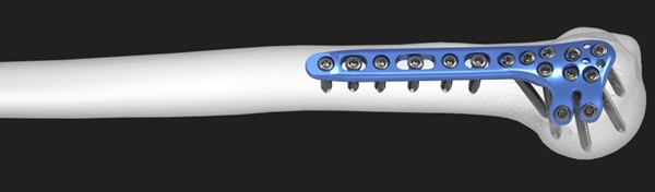 Acumed Polarus 3 | OneMed