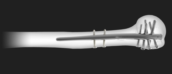 Acumed Polarus 3 | OneMed