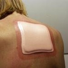 Haavasidos Allevyn Adhesive, 17,5x17,5cm kiin ster 10KPL - Allevyn