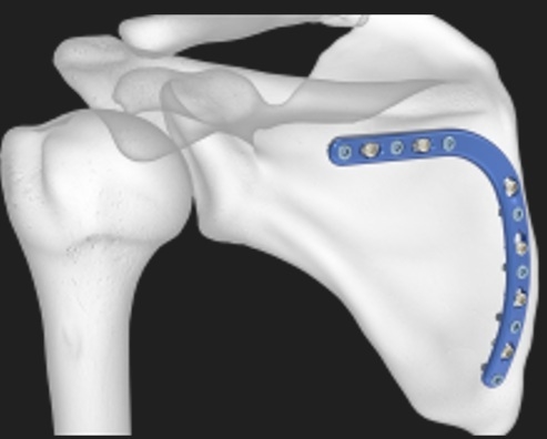 Acumed Scapula Plating System | OneMed