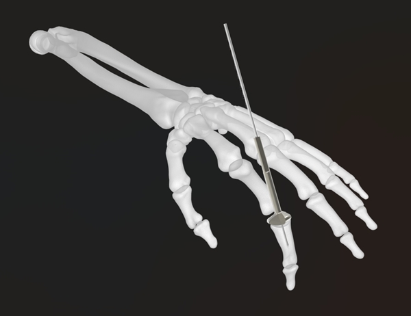 Acumed Small Joint Reamer | OneMed