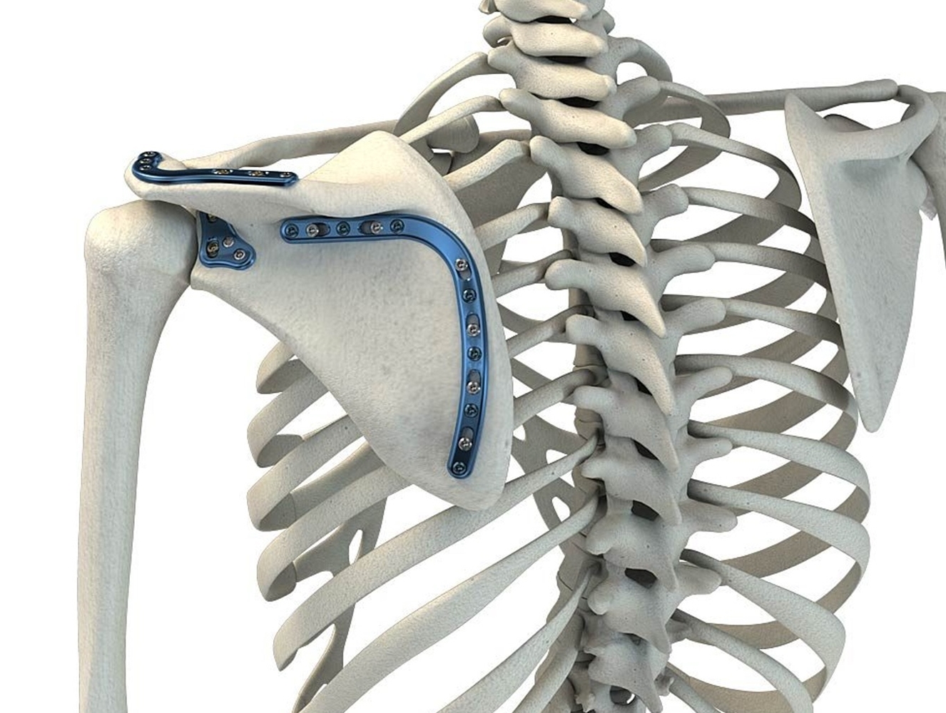 Acumed Scapula Plating System | OneMed