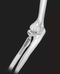 Acumed Anatomic Radial Head | OneMed