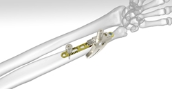 Acumed Osteotomy System | OneMed
