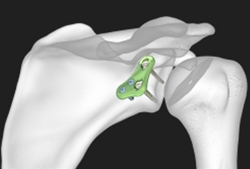 Acumed Scapula Plating System | OneMed