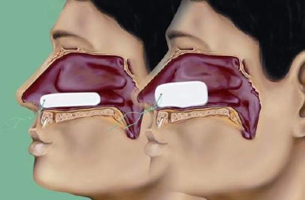 Nesetamponade u/rør Raucocel, 100mm rett - Raucocel - 2