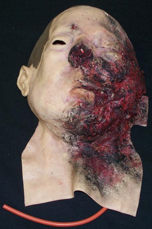 Ansikt eksplosjonsskade