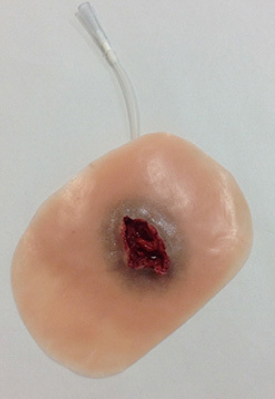 Utgangssår blødende, 1 stk refill til X-treme 2