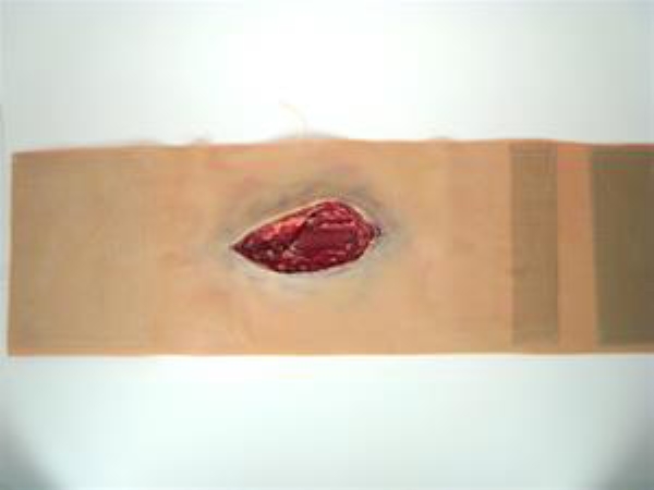 Lår laserasjon, 1 stk refill Moulage Kit