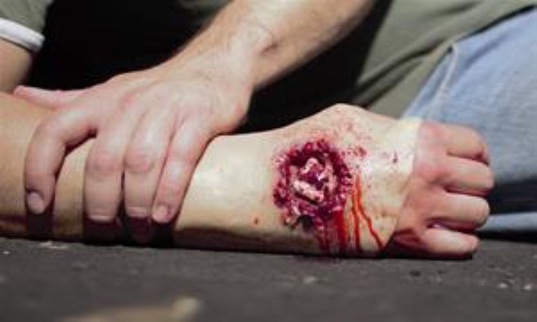 Skuddskade gjennom hånd, 1 stk refill Moulage Kit