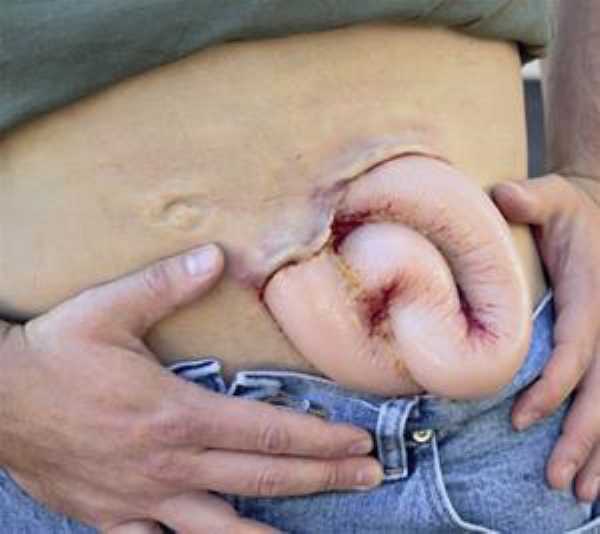 Innvollsskade utvendig, 1 stk refill Moulage Kit