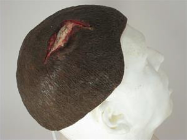 Hodebunn åpent sår, 1 stk refill Moulage Kit