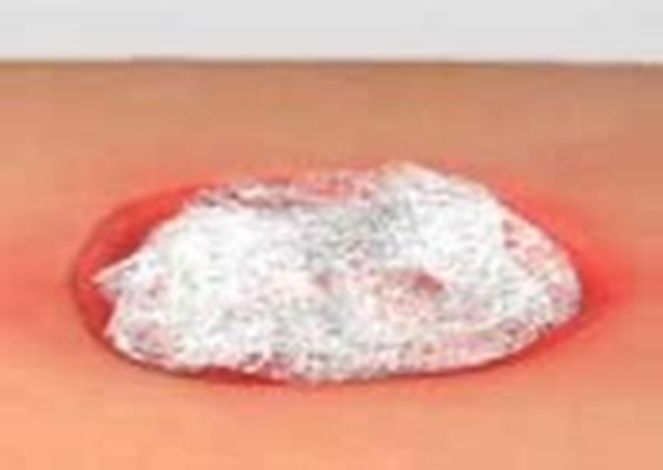 Undertryck Sårfyllnad gasväv Pico, 11,4cmx3,7m - PICO