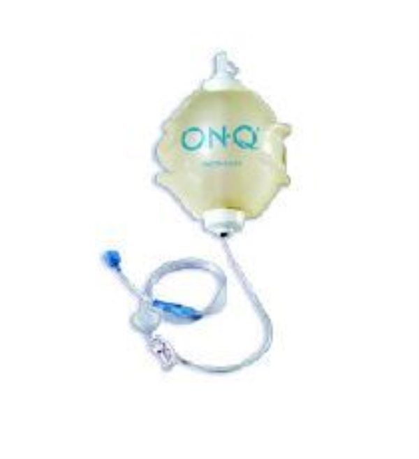 Pump ON-Q Painbuster, 100mlx2ml/h 6,5 cm kateter