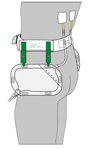 Bältesset SAUER NephSys Comfort, Upphängning av urinpåse midje - SAUER - 1