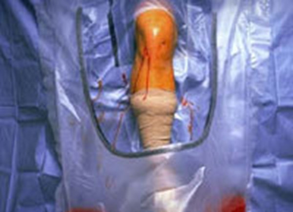 Op set Knä allt-i-ett Steri-Drape, 226x320cm uppsamlingspåse