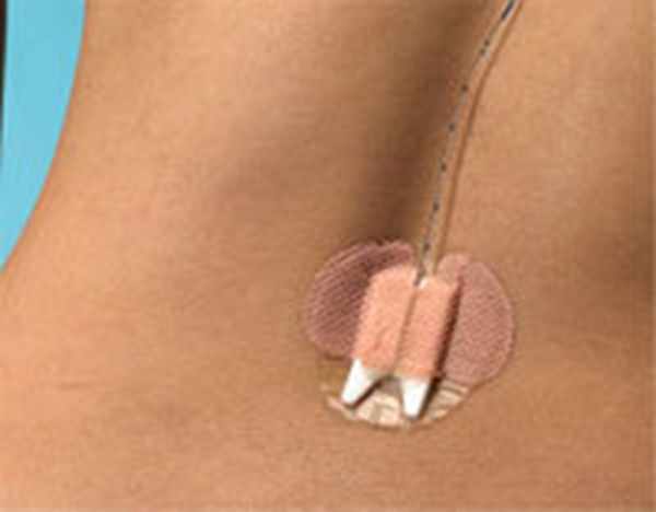 Fixeringsförband Epi-Guard, för epiduralkateter